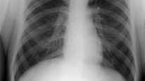 Akciğer Grafisi